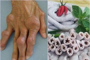 Người bệnh gút nên và không nên ăn gì? 