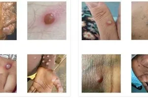 4 giai đoạn từ nhẹ đến nặng của bệnh đậu mùa khỉ 