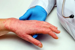 Bộ Y tế hướng dẫn phân biệt đậu mùa khỉ với đậu mùa, thủy đậu, tay chân miệng 