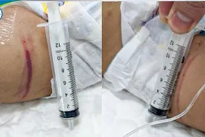 Sức khỏe hiện tại của bé gái 18 tháng tuổi nghi bị bạo hành tại Hà Nội 