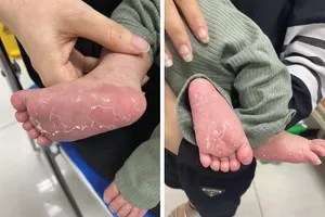 Bé 46 ngày tuổi bị giang mai 