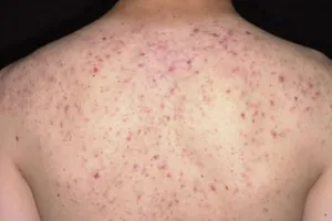 Đến spa tẩy mụn trứng cá ở lưng, người phụ nữ suýt mất mạng 