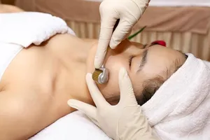 Lăn kim có điều trị được mụn trứng cá? 