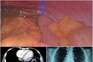 Hi hữu: Vỡ cơ hoành, đại tràng, dạ dày nam thanh niên chui lên khoang phổi 