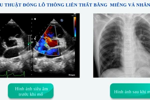 Tạm dừng tim để vá thông liên thất cho bé trai có lồng ngực hình ức gà 