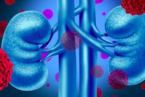 5 dấu hiệu cảnh báo ung thư thận