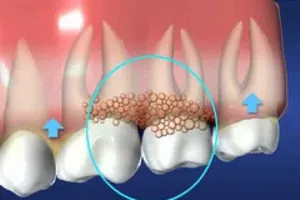 Infographic: 8 cách đơn giản trị sưng viêm nướu răng