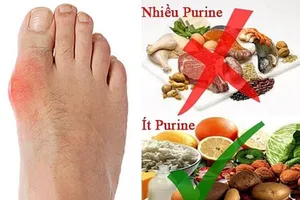 Bị gout, kiêng cữ ăn uống trong ngày Tết ra sao?