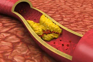 Mỡ trong máu cao nguy hiểm ra sao?