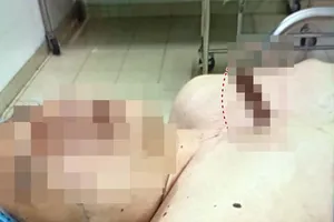 Cấp cứu bệnh nhân bị 1 con dao cắm giữa ngực