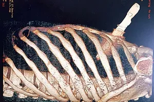 Cứu sống bệnh nhân bị dao cắm thủng tim