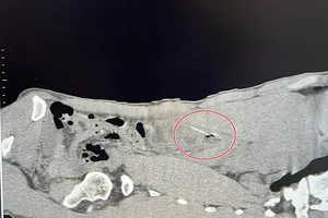 Cấp cứu nam thanh niên nuốt tăm xỉa răng đâm thủng tá tràng, túi mật, viêm phúc mạc