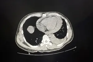 Cứu thợ hồ bị đâm thủng tim, thủng phổi 