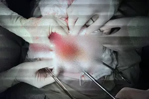  Bình Thuận: Cụ ông 89 tuổi bị khối bã thức ăn gây tắc ruột