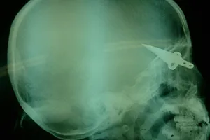 Hội chẩn từ xa cứu cháu bé bị dao găm vào não