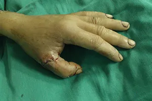 Nối lại thành công hai ngón tay bị cưa máy gỗ cắt đứt