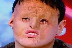 Lấy mảng lớn da bụng ghép lên mặt