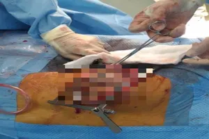 Cắt bỏ khối u gần 7 kg trong lồng ngực bệnh nhân