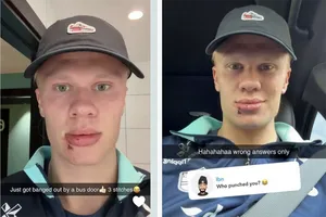 Haaland đập mặt vào cửa kính phải khâu 3 mũi: Nổi giận và đùa vui