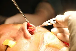 Silicon hóa 'đá' sau 30 năm bơm vào mũi