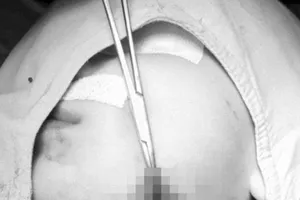 Hóc xương cá lóc 5 ngày, cổ họng bé gái đầy ổ áp xe