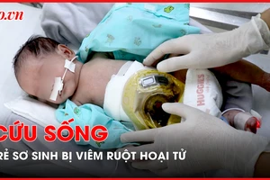 Cứu sống trẻ sơ sinh 4 ngày tuổi bị viêm ruột hoại tử