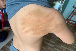 Bà nội trợ dạy kèm tại nhà đánh bầm vai học sinh lớp 5