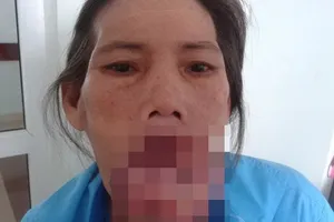Phẫu thuật loại bỏ khối u 'khổng lồ' ở môi dưới