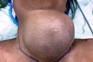 Mổ lấy khối u tuyến giáp 1,2 kg ra khỏi cổ bệnh nhân