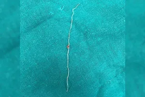 Tìm thấy giun 12 cm từ má của người phụ nữ bị muỗi đốt