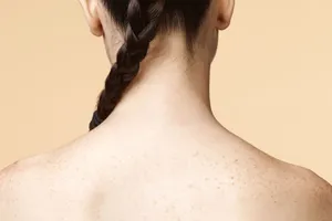 Bí quyết 'thổi bay' mụn lưng