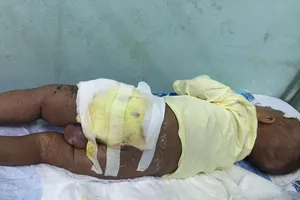 Bé trai nguy kịch vì mẹ đắp lá cây chữa nhọt