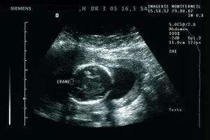 Chữa dị tật cho thai nhi từ trong bụng mẹ