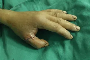 Nối thành công nhanh ngón tay đứt lìa