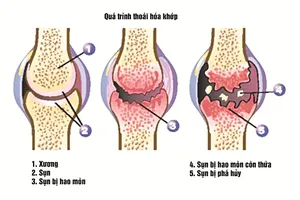 Năm 2020, thoái hóa khớp là nguyên nhân thứ tư gây tàn phế