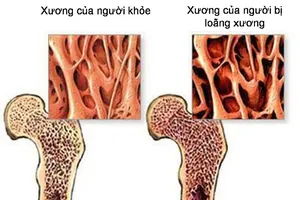 Người cao tuổi và bệnh xương khớp