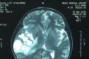 Nghi u não, mổ ra là ổ ấu trùng sán dải heo