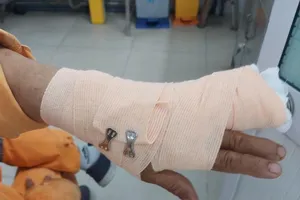 Công an nêu lý do nhân viên điện lực bị đánh đứt gân ngón tay