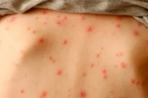  83 ca mắc thủy đậu tại Bến Tre làm việc cùng công ty may mặc