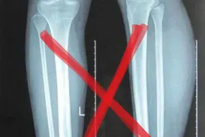 Nguyễn Xuân Son vừa nhập viện đã xuất hiện phim x quang 'fake'