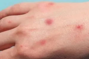 Chủ tịch tỉnh Cà Mau chỉ đạo hoả tốc phòng chống bệnh đậu mùa khỉ