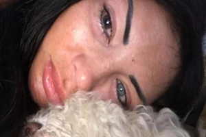 Người mẫu gần mù vì tiêm silicone đổi màu mắt