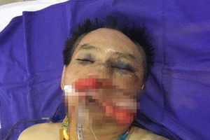Nguyên đại tá công an đánh anh ruột thương tích nặng