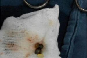 Bé gái 14 tháng tuổi suýt mất mạng do nuốt phải dị vật