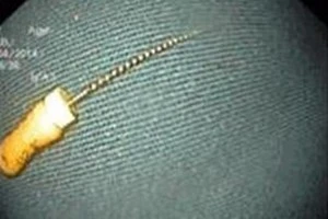 Bé trai 4 tuổi nguy kịch vì nuốt phải cây kim dài 3,5cm 