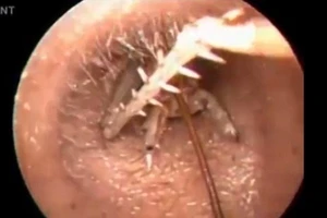 Kinh dị: Bác sĩ kéo dế ‘khủng’ khỏi lỗ tai người