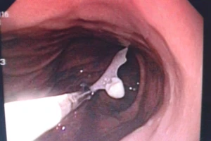 Gắp răng giả ra khỏi dạ dày nữ bệnh nhân