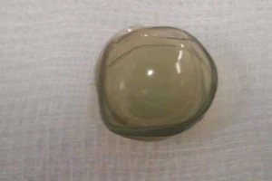 Gắp 27 kính áp tròng cụ bà để trong mắt 35 năm