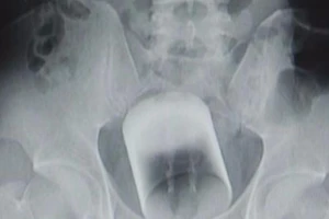 Bác sĩ đau đầu ca bệnh ly nước kẹt trong ... hậu môn