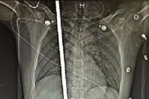Sống sót kì diệu dù bị thanh sắt 2m đâm xuyên người
